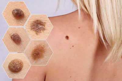 Warning Signs of Skin Cancer You Shouldn't Ignore