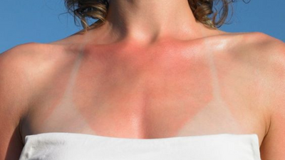 How To Properly Treat A Sunburn